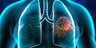 Akciğer kanserinin belirtileri nelerdir? Akciğer kanseri tedavisi var mıdır?